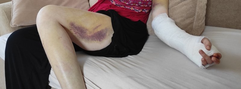 Beyzbol sopasıyla dövülen kadın yaşadıklarını anlattı