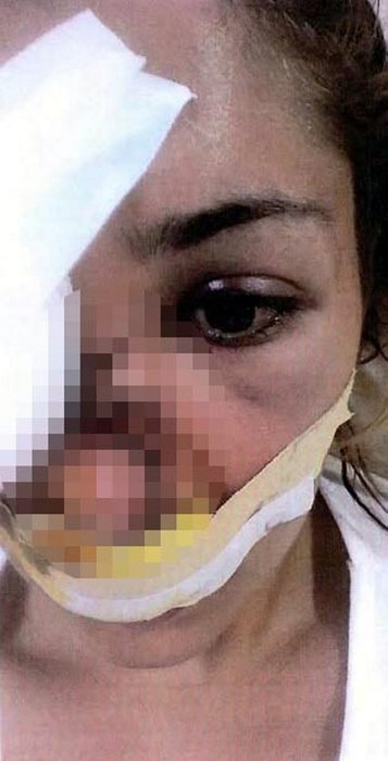 Sevgilisi tarafından şiddete uğrayan Tuğçe hukuk mücadelesi başlattı