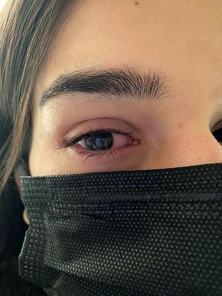 Göz iltihabı salgını yeniden başladı! Uzmanlar adenovirüse karşı uyarıyor... Bu belirtilere dikkat