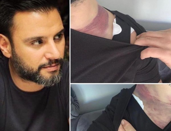 Alişan’ı ölümle burun buruna getiren ’göbek yağı’ davasında gelişme!