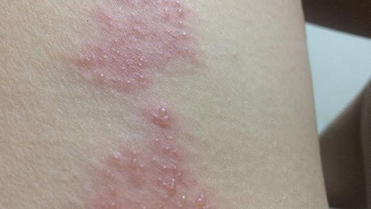 Zona hastalığı nedir, belirtileri nelerdir? Zona hastalığı tedavisi var mı?