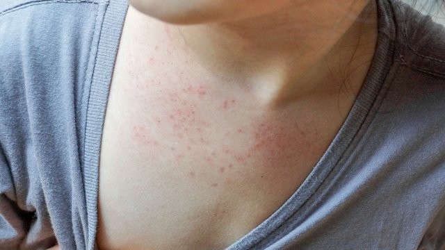 Gül hastalığı nedir, belirtileri nelerdir? Gül hastalığının nasıl tedavi edilir?