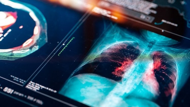 Zatürre Pnömoni nedir? Zatürre belirtileri nelerdir?