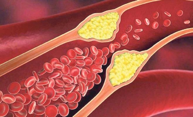 İdrar yolu enfeksiyonuna çare: Kızılcık suyu