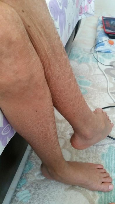 İzmir’de balık pulu hastası Kayra yaşadığı zorlukları anlattı: Evden çıkamıyorum