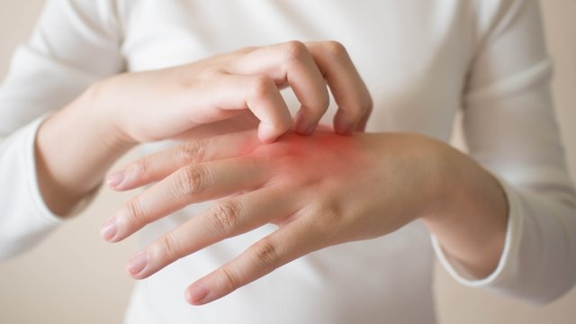 Egzama nedir? Egzama belirtileri nelerdir?