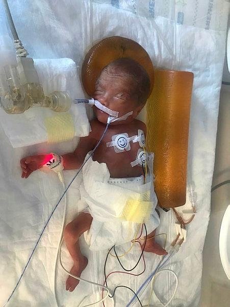 Mucize bebek İdil, yaşama tutundu