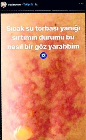 Sırtında sıcak su torbası patladı!