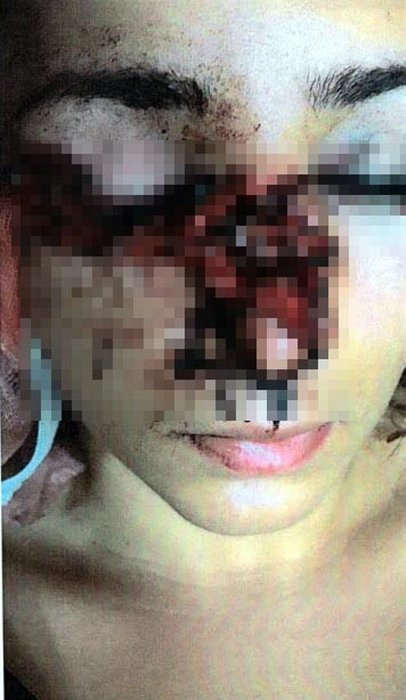 Sevgilisi tarafından şiddete uğrayan Tuğçe hukuk mücadelesi başlattı