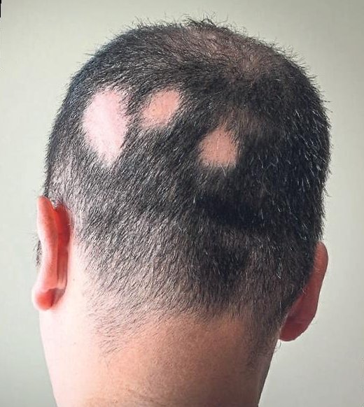 Uyku apnesine ne iyi gelir?