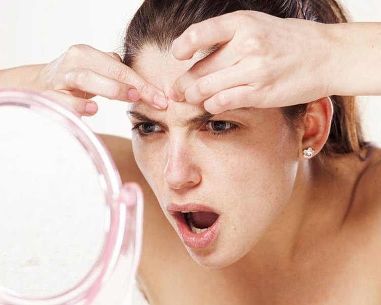 Sivilce nasıl geçer? Sivilce izi nasıl yok olur?