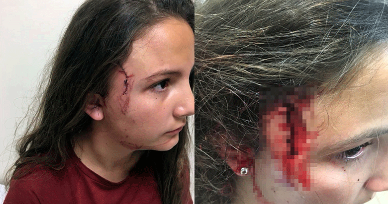 Tekirdağ’da küçük kıza ’pitbull’ saldırdı