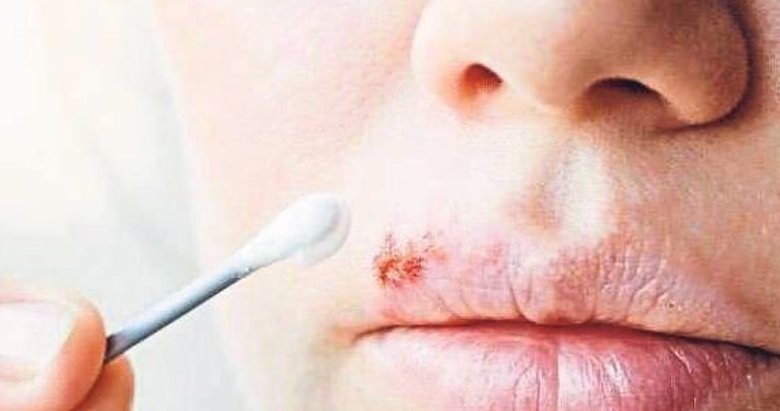 Sık uçuk çıkarıyorsanız dikkat!