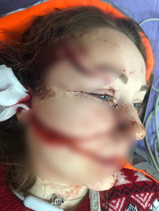 Falçatalı saldırıya uğrayan Anna Butim yaşadıklarını anlattı