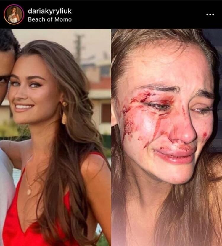 Dünyaca ünlü model Daria Kyryliuk Çeşme’de saldırıya uğradı