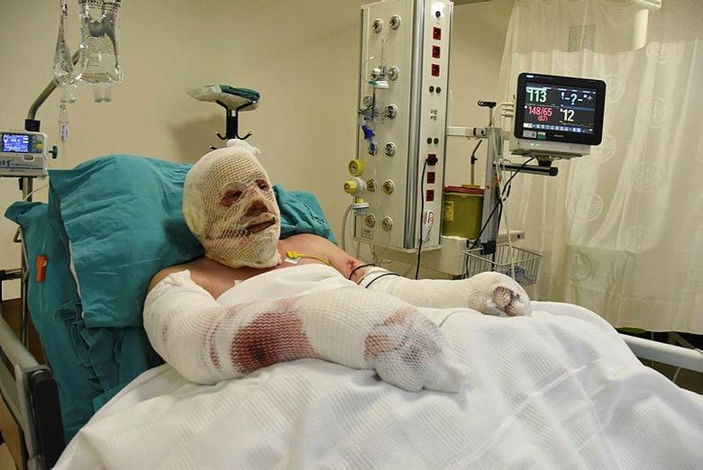 Yangınla savaşırken alevler arasında kaldı! Yaşadığı dehşet anlarını böyle anlattı