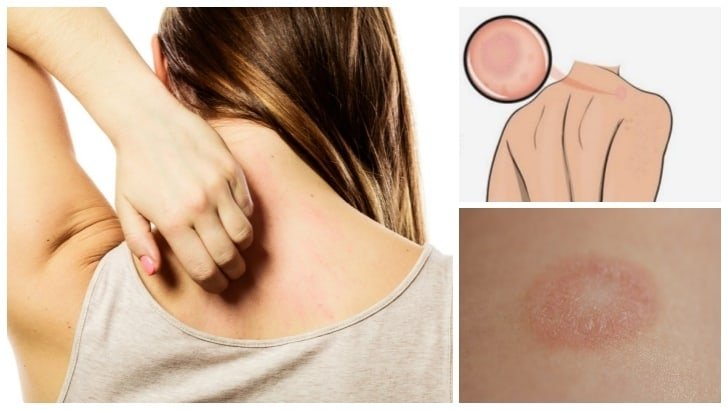 Rozasea Gül hastalığı nedir? Sebep, belirtileri ve tedavi yöntemleri nelerdir?