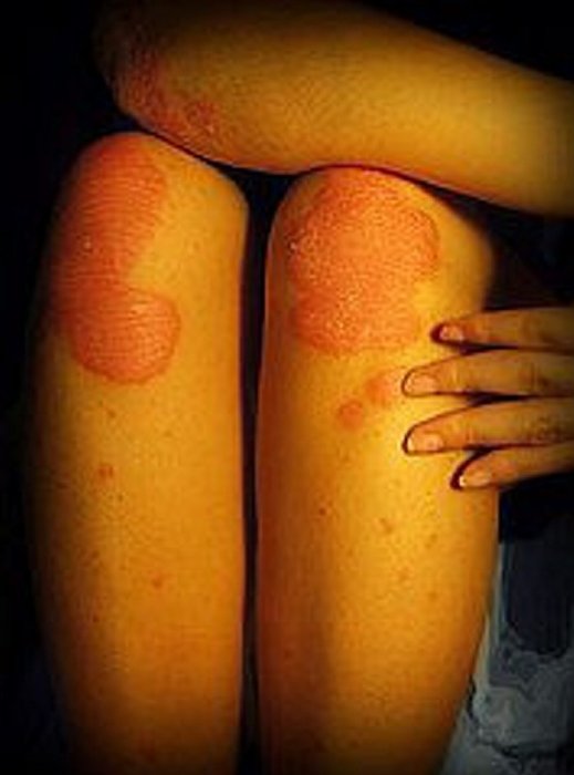 Sedef hastalığı nedir ve belirtileri nelerdir? Sedef hastalığı nasıl tedavi edilir?