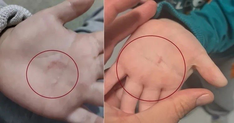 Balıkesir’deki kreşte skandal görüntü! 4 yaşındaki çocuğun eline tırnaklarını geçirdi