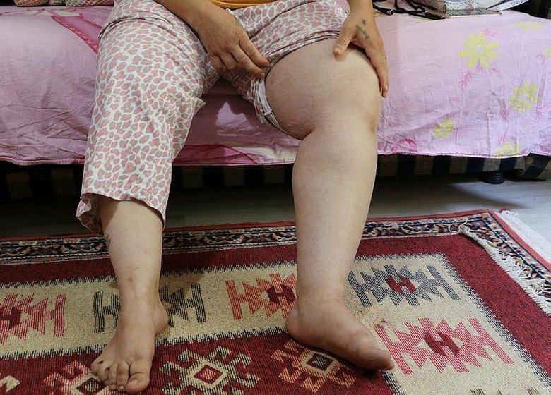 Denizli’de karın gerdirme ameliyatı olan kadının hayatı kabusa döndü