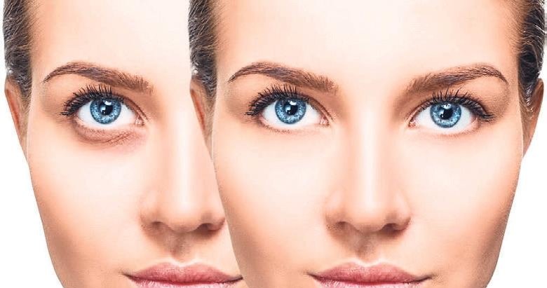 Göz altı morluklarına vitamin dopingi