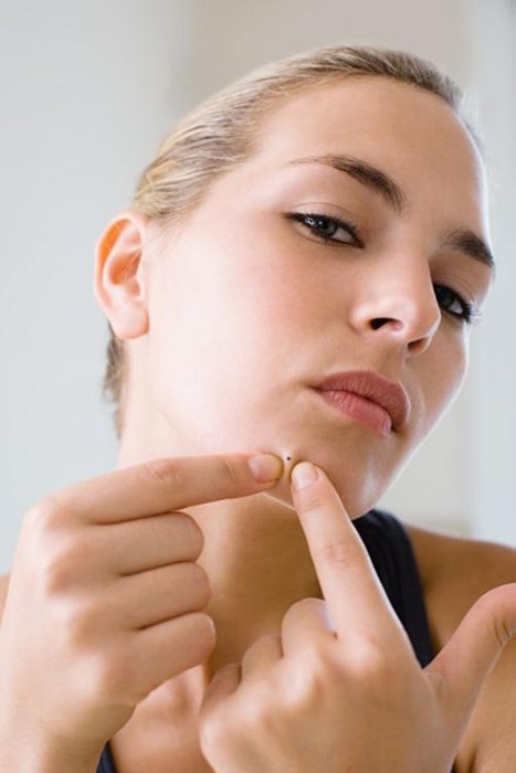 Sivilce nasıl geçer? Sivilce izi nasıl yok olur?