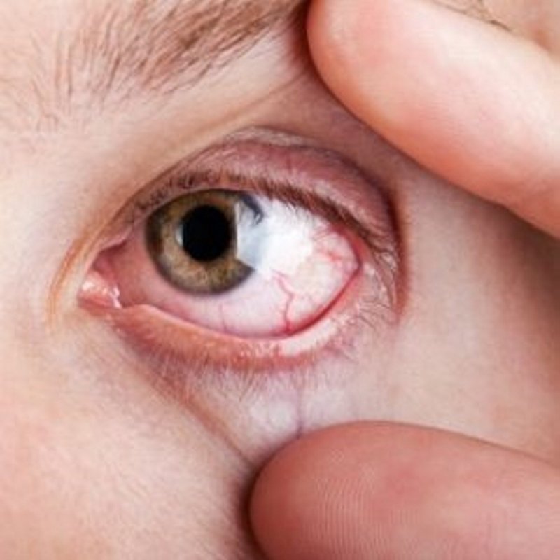 Uzmanından önemli uyarı: Göz ağrısını hafife almayın!