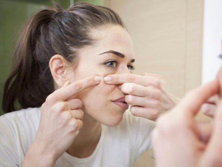 Sivilce nasıl geçer? Sivilce izi nasıl yok olur?