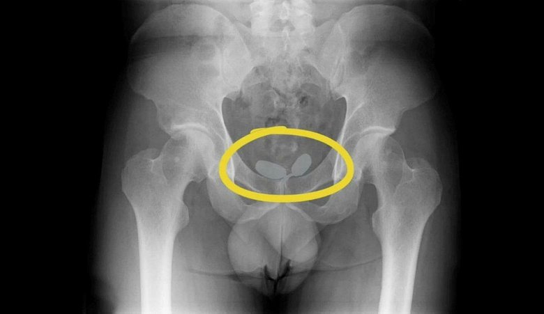 İzmir'de havalimanında vücutlarına gizledikleri uyuşturucuyla yakalanan 5 kişi yakalandı