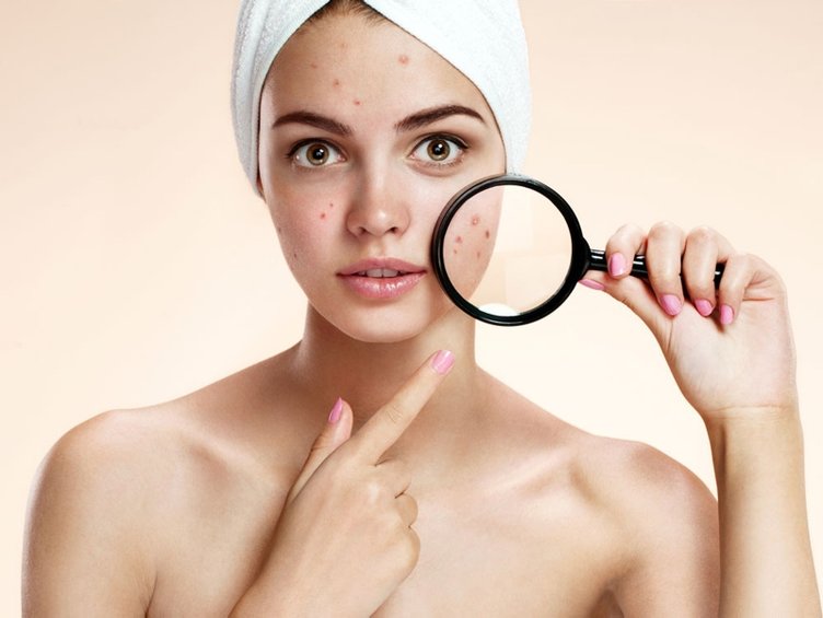 Sivilce nasıl geçer? Sivilce izi nasıl yok olur?