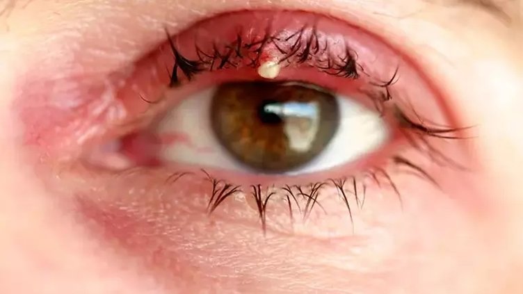 Arpacık nedir? Neden çıkar? Arpacık tedavisi nasıl yapılır?