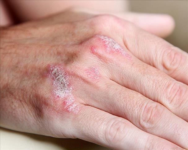 Sedef hastalığı nedir ve belirtileri nelerdir? Sedef hastalığı nasıl tedavi edilir?