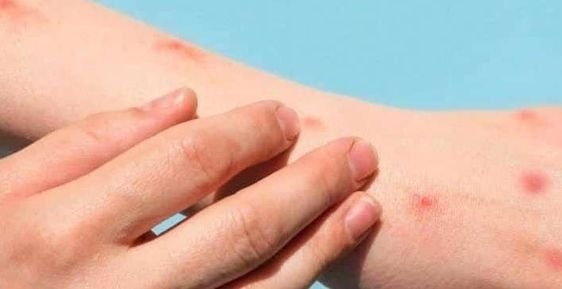 DSÖ, maymun çiçeği virüsü sebebiyle acil durum ilan etti