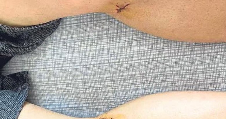 Kapalı kalp ameliyatında iyileşme süresi çok kısa