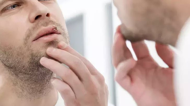 Dudaktaki uçuk en hızlı nasıl geçer? İşte püf noktaları