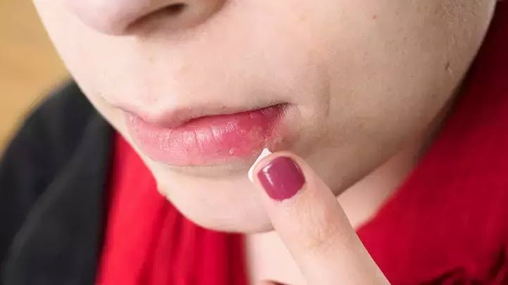 Dudaktaki uçuk en hızlı nasıl geçer? İşte püf noktaları