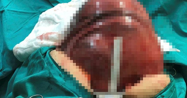 Karınlarındaki kitlelerden aynı gün kurtuldular