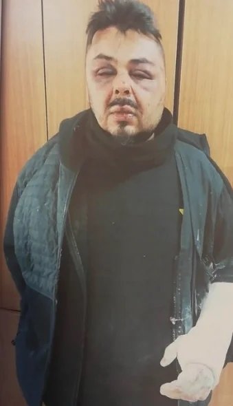 DM’den yürüyen şarkıcının kemiklerini çatır çatır kırdılar! Artık tanınmaz halde...