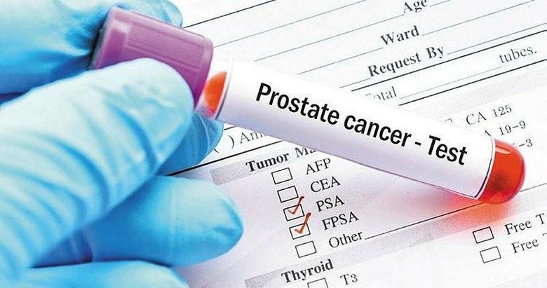 Genetik yatkınlık prostatta riski artırıyor