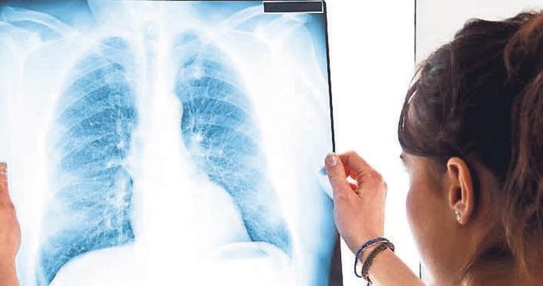 Akciğer kanserinde fitoterapi uygulaması