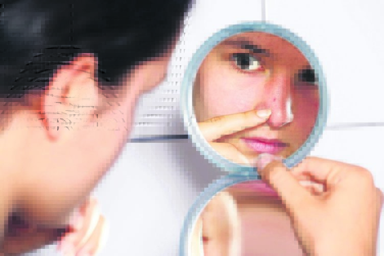 Sivilce nasıl geçer? Sivilce izi nasıl yok olur?