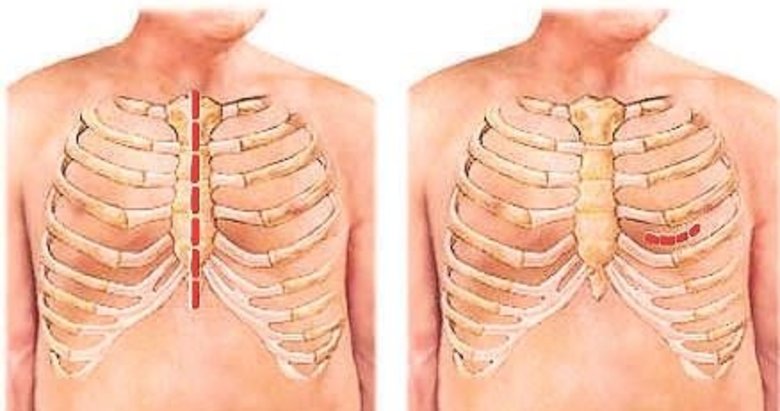 By-Pass cerrahisinde kapalı yöntem daha konforlu