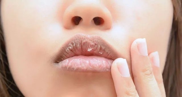 Bunu yaparsanız dudaklarınız artık çatlamaz! Dudak çatlamasına ne iyi gelir? En doğal yöntemler nelerdir?