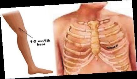 İngiliz hasta kapalı yöntemle By-Pass için Türkiye’ye geldi