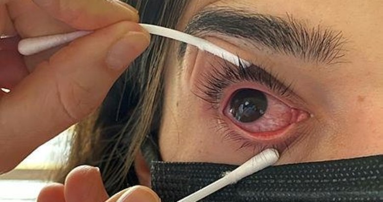 Göz iltihabı salgını yeniden başladı! Uzmanlar adenovirüse karşı uyarıyor... Bu belirtilere dikkat