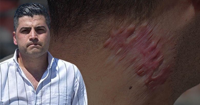 Lazer tedavisi sonrası hayatı karardı! Soluğu mahkemede aldı