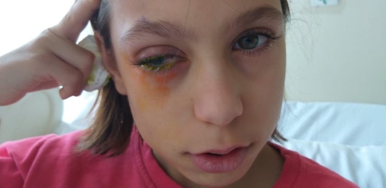 İzmir’de bir çocuk poşet açarken gözünü bıçakladı