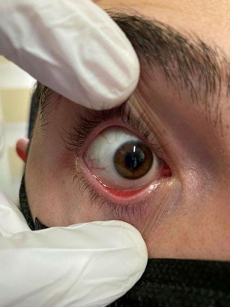 Göz iltihabı salgını yeniden başladı! Uzmanlar adenovirüse karşı uyarıyor... Bu belirtilere dikkat